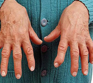 آرتریت روماتوئید چیست؟