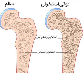 پوکی استخوان درمان دارد؟