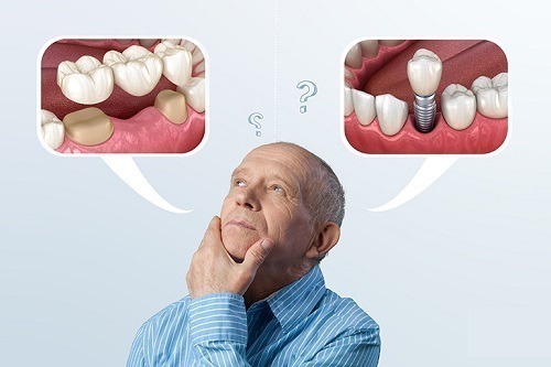 ایمپلنت بهتر است یا بریج دندان؟ مقایسه کامل، مزایا و معایب